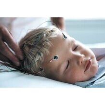 Ambu Neuroline 726 Cup Electrodes in Use